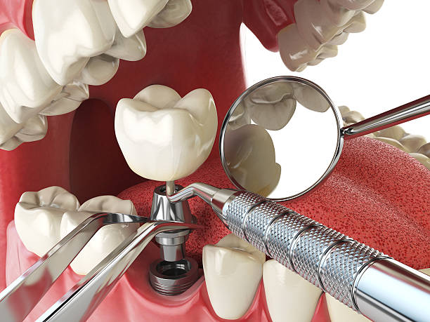 Best Emergency Denture Repair in Salina, UT